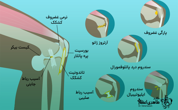 درمان زانو درد شدید در خانه