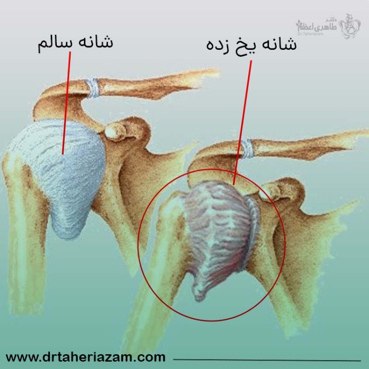 شانه یخ زده چیست و چه علائمی دارد؟ نحوه درمان شانه یخ زده