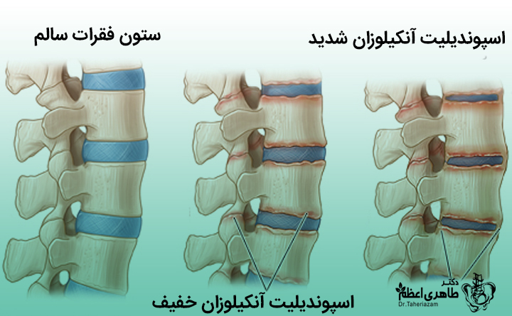 بیماری hip چیست