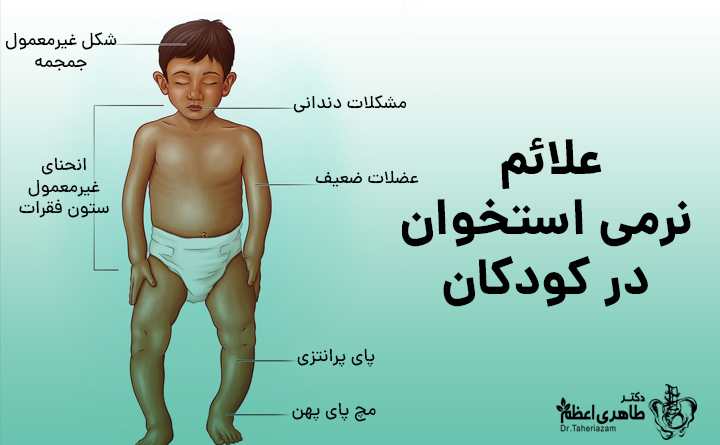 علائم راشیتیسم