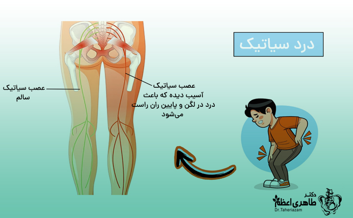 ورزش برای سیاتیک