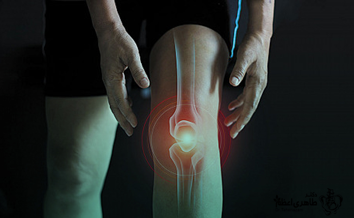 آرتروز زانو 