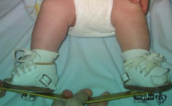 جراحی کلاب فوت