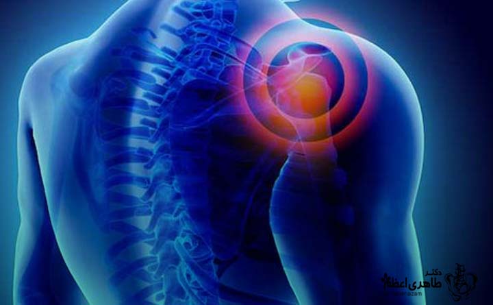 علائم شانه یخ زده 