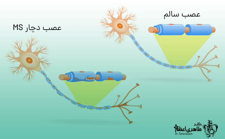 بیماری ام اس