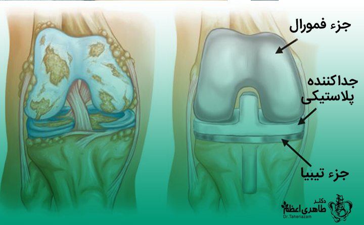 جراحی تعویض مفصل زانو