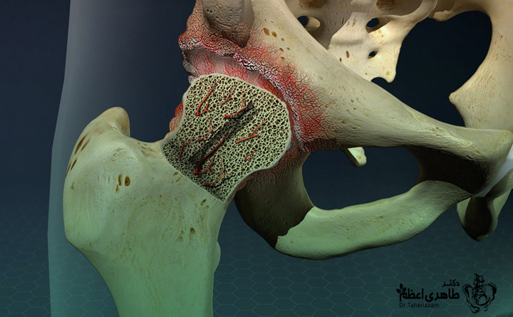 علائم سیاه شدن سر استخوان ران چیست