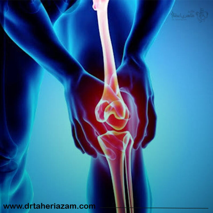 آیا آرتروز زانو خطرناک است؟ 