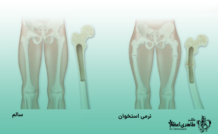 علل راشیتیسم چیست؟