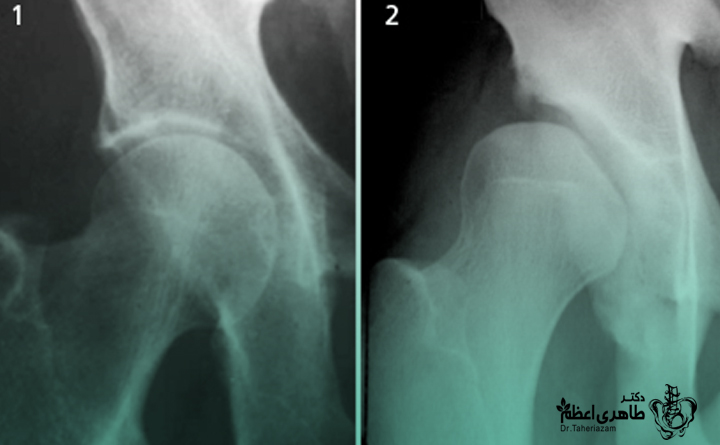 درمان دیسپلازی هیپ