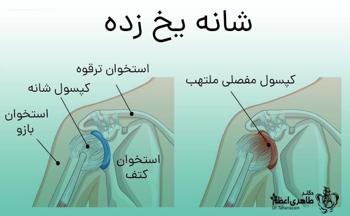 شانه یخ زده چیست؟
