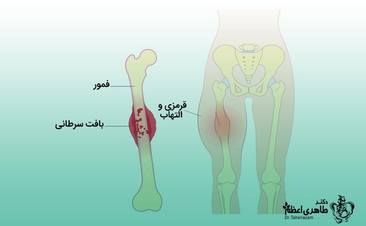 تومور خوش خیم استخوان در کودکان