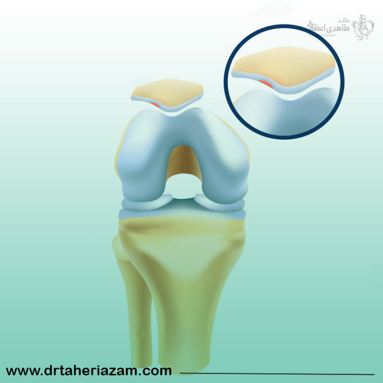 ساییدگی کشکک زانو یا کندرومالاسی چیست؟ علائم و درمان ساییدگی کشکک