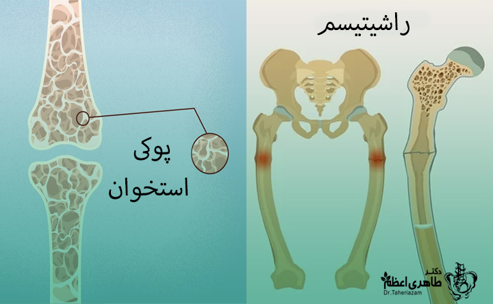نرمی استخوان در مقایسه با پوکی استخوان