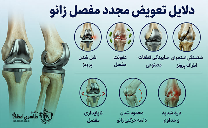 دلایل نیاز به تعویض مجدد مفصل زانو