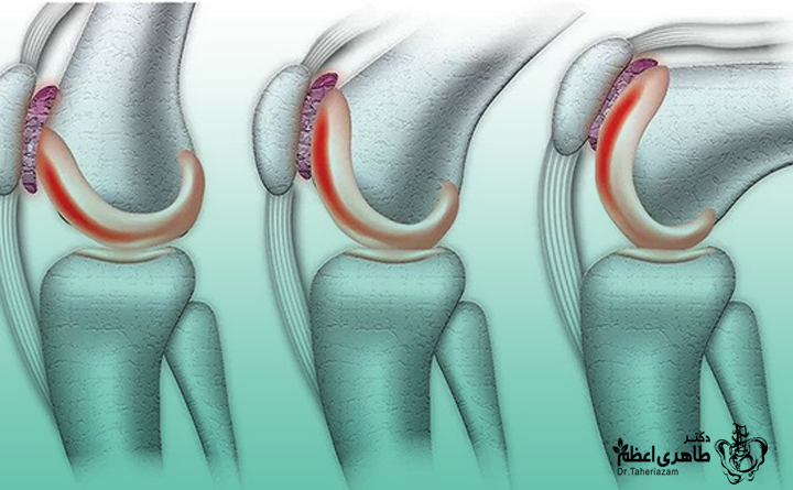 ساییدگی کشکک 