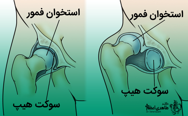 دیسپلازی هیپ چه دلایلی دارد؟