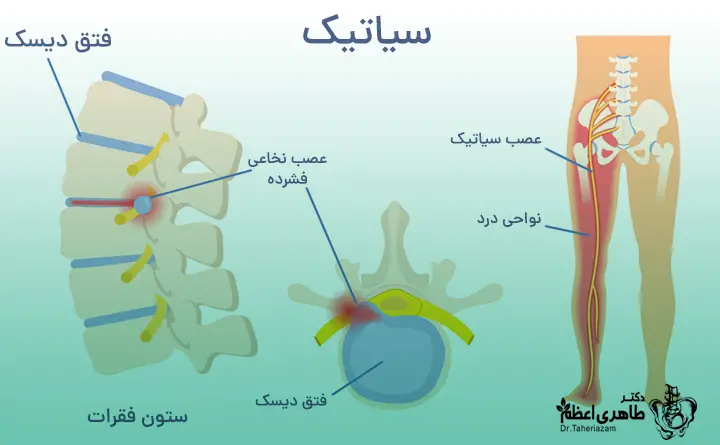 درد سیاتیک