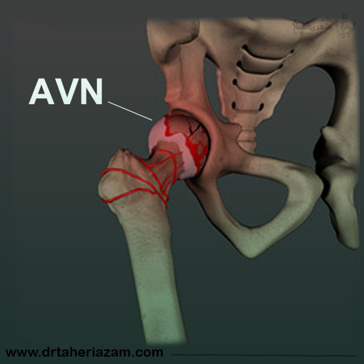 سیاه شدن سر استخوان ران یا نکروز آواسکولار چیست؟ + تشخیص و درمان