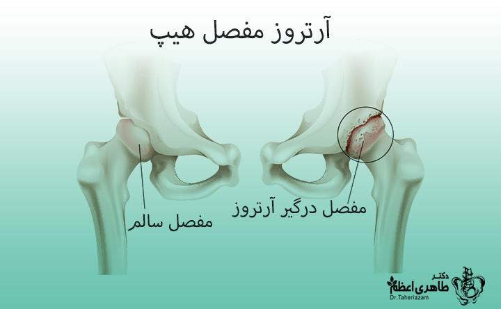 دلیل بروز بیماری آرتروز لگن