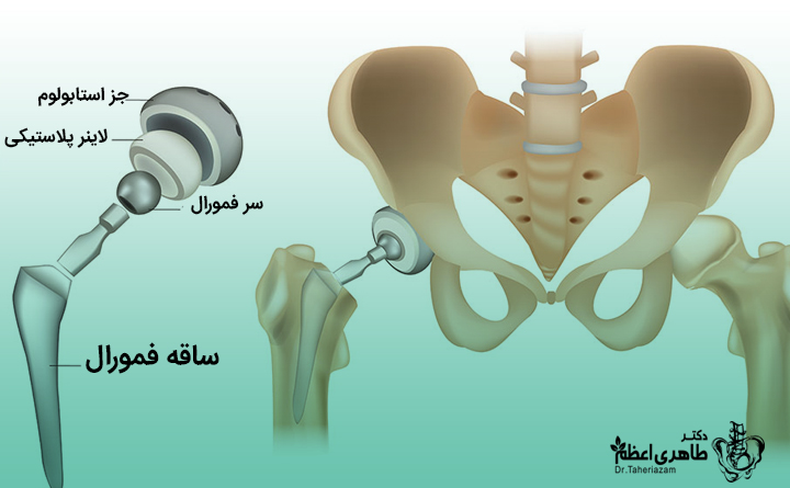 عمل جراحی هیپ