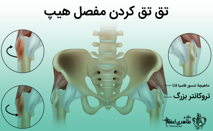 چیبخوریم برای درمان تق تق لگن