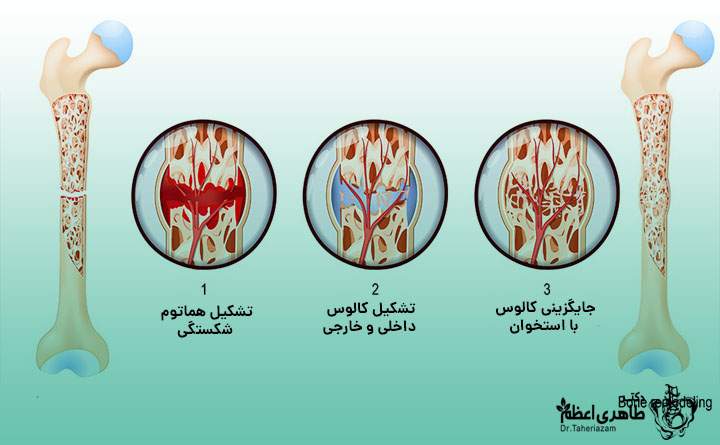 چقدر طول میکشد تا استخوان جوش بخورد؟