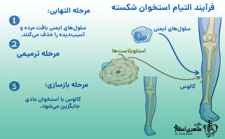 ترمیم شکستگی استخوان