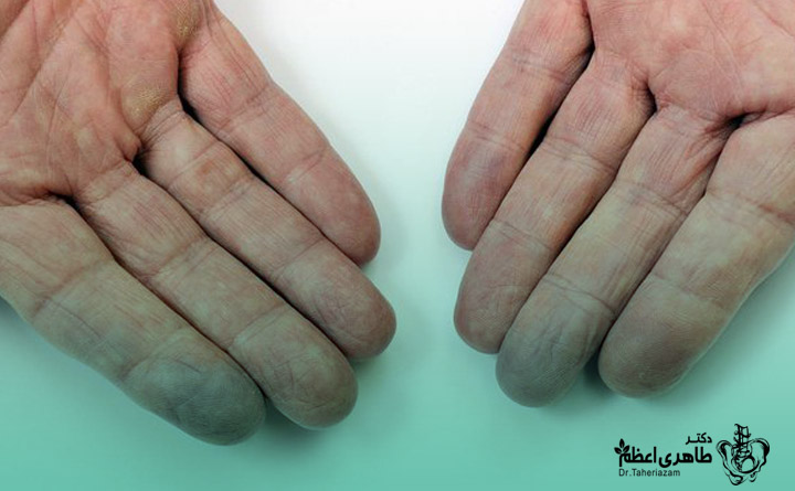 گردش خون و خواب رفتن دست و پا