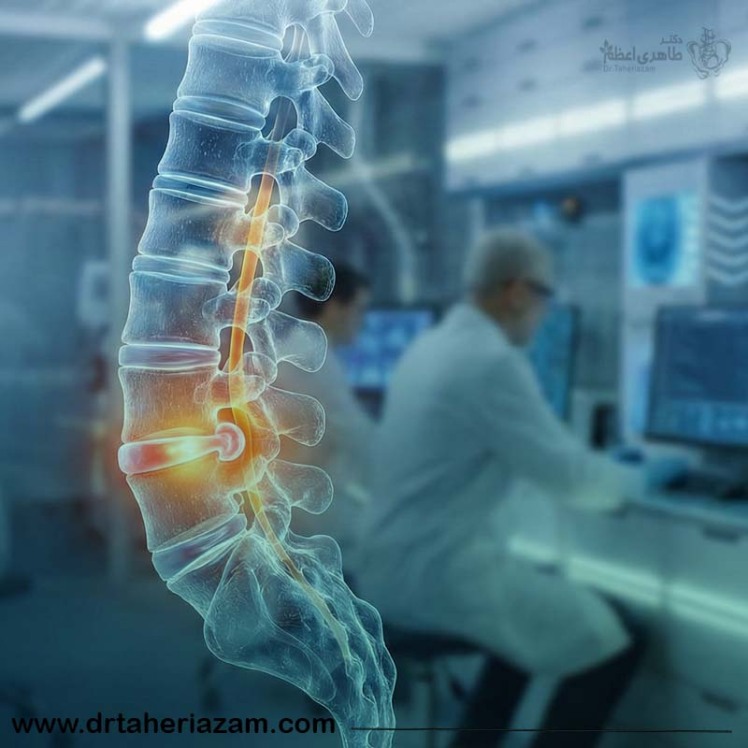 دیسک کمر چیست؟ تشخیص و درمان کیست کمر