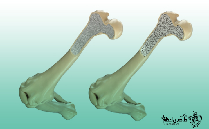 پوکی استخوان