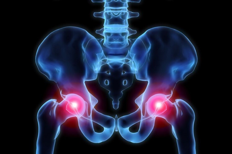 درد مفصل ران و لگن نشانه چیست | چگونه می‌توان از شر این درد خلاص شد؟