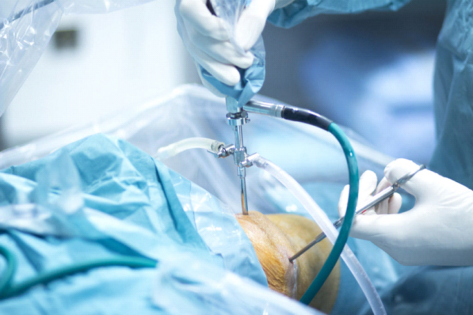 آرتروسکوپی زانو | تشخیص و درمان بسیاری از مشکلات زانو با این روش جراحی