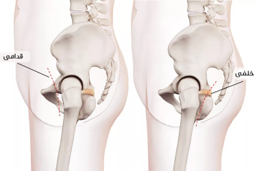 روش تعویض مفصل ران‌ خلفی (Posterior Hip Replacement Approach)