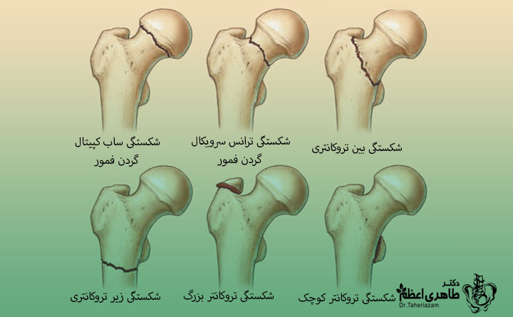 شکستگی فمور