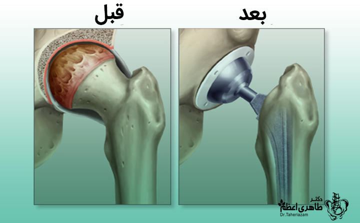 دلایل جراحی هیپ