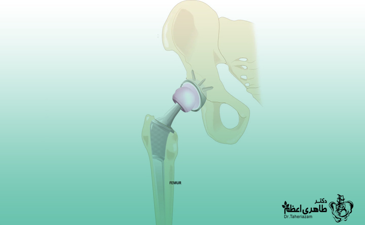  ایمپلنت‌های جدید برای جراحی‌های تعویض هیپ