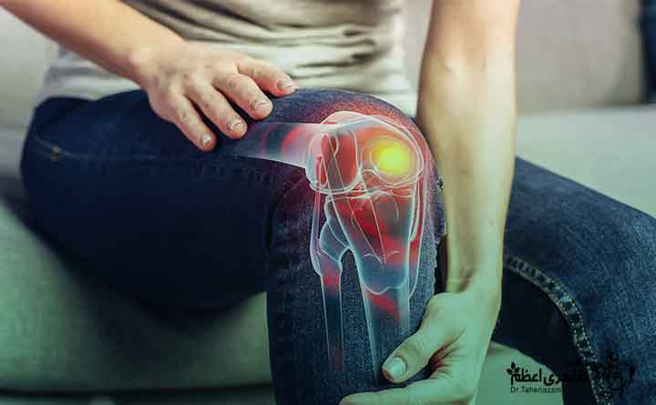 راه های پیشگیری از آرتروز زانو