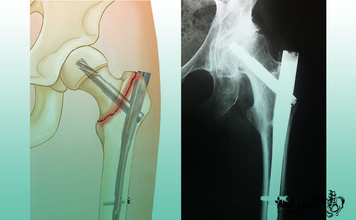 شکستگی هیپ در ناحیه اینترتروکانتریک
