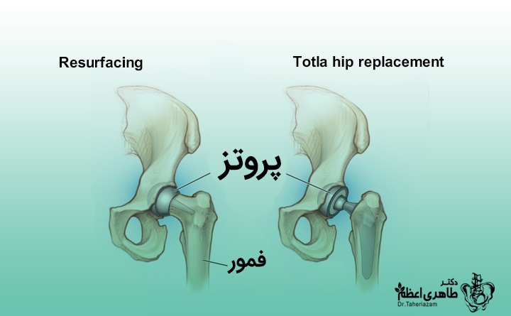 پروتز مفصل هیپ