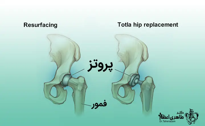 پروتز مفصل هیپ