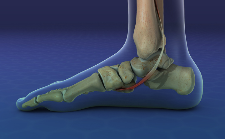 دکتر طاهری برای کف پای صاف