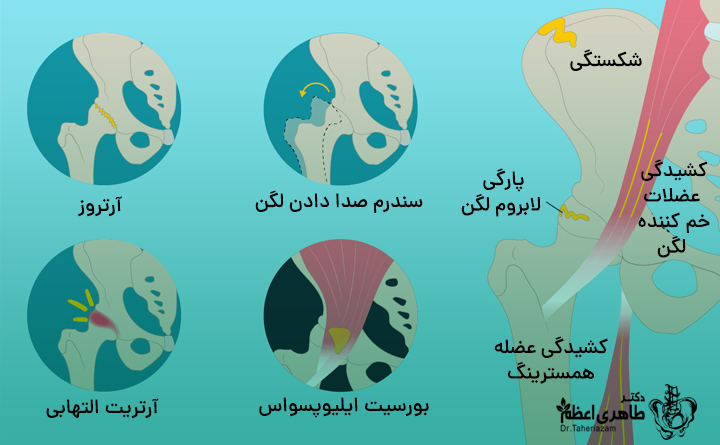علل لگن درد چیست؟