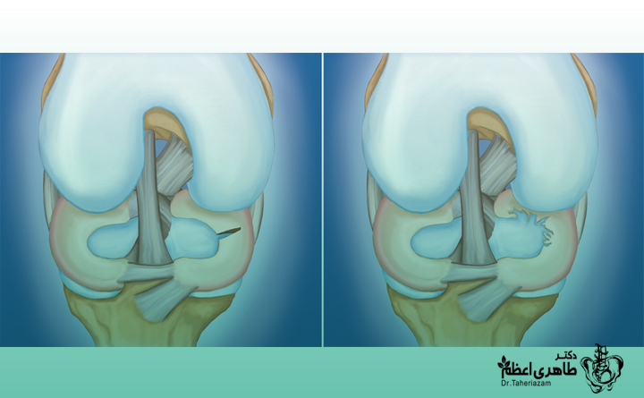 پارگی مینیسک زانو درد دارد؟