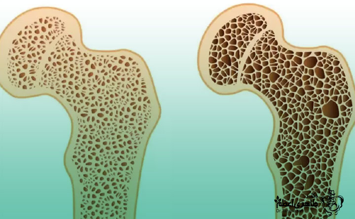 مراقبت های بعد از درمان پوکی استخوان