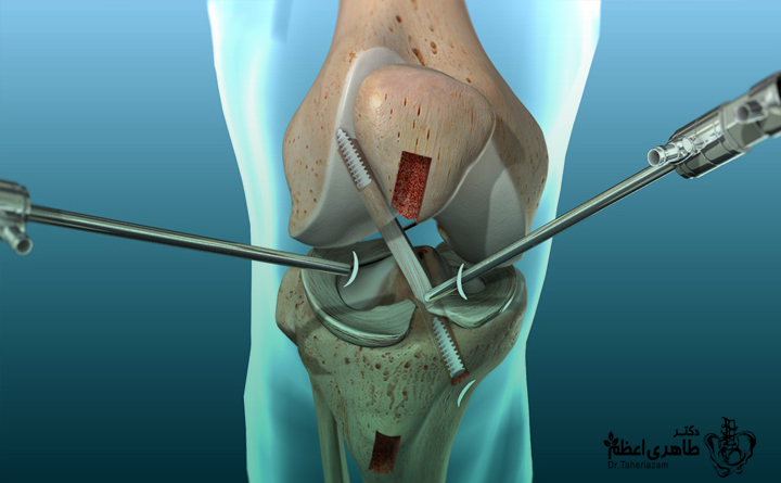 جراحی پارگی رباط صلیبی