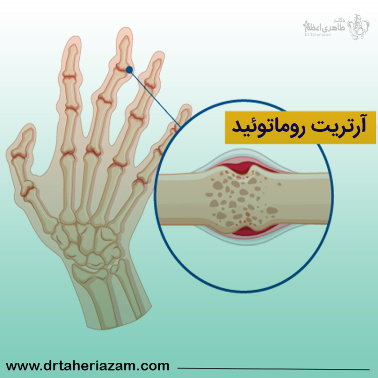 بیماری آرتریت روماتوئید یا روماتیسم | علل و درمان