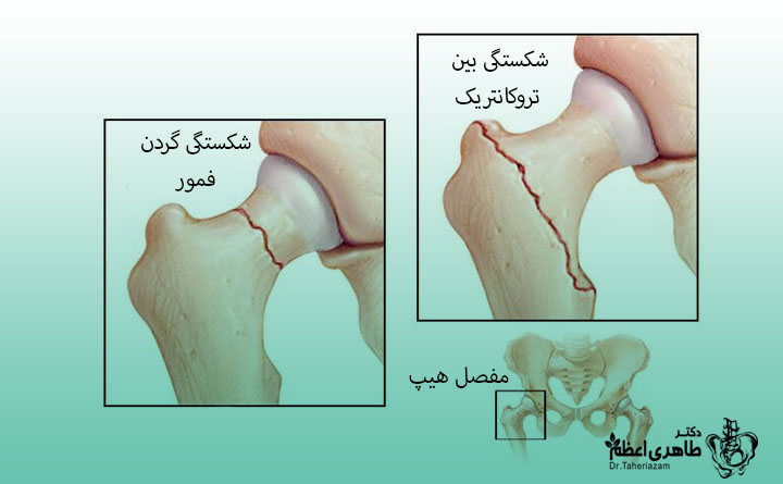 شکستگی استخوان ران