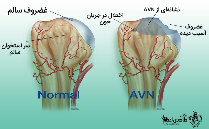 سیاه شدن سر استخوان ران یا نکروز آواسکولار 