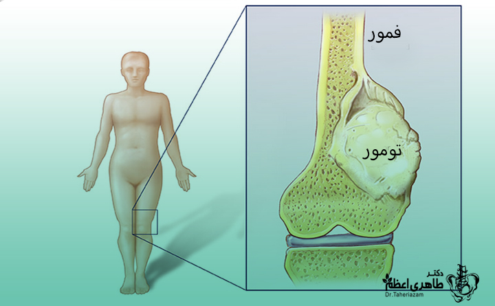 ضایعات استخوانی